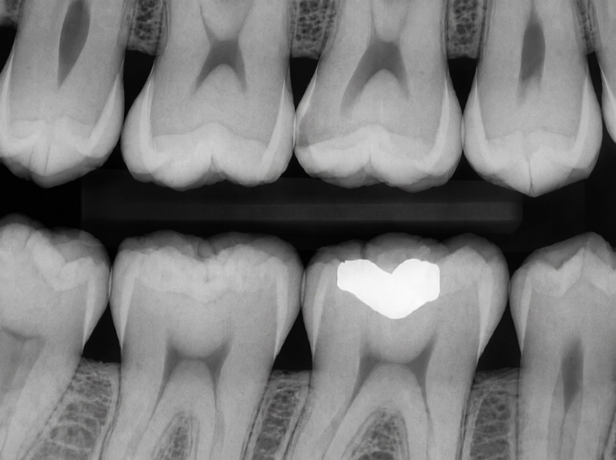 Root canal alternatives and prevention at ELEV8 Biological Dentistry, Beverly Hills